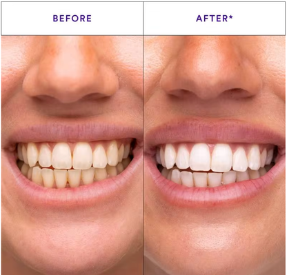 (New) Bandes Dentaires Violettes Anti-Jaunissement "Formule Concentré" ⭐️ (